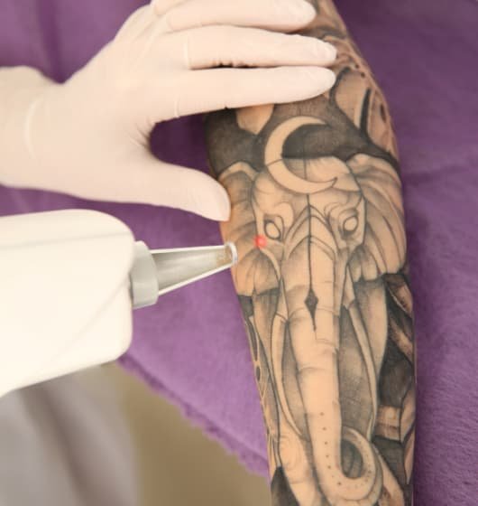 sesión de remoción láser tatuaje en Toluca