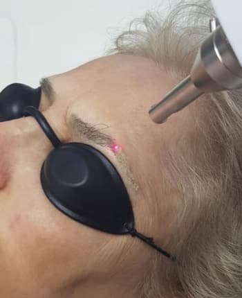 Elimina tatuajes y micropigmentacion en la mejor clinica de Toluca