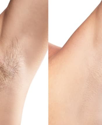 Servicio profesional de depilación en Brazilian Beauty