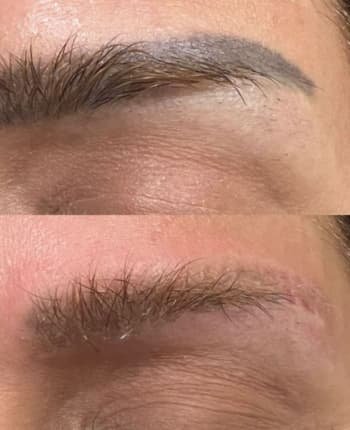 remoción de tatuajes con láser picosegundos en Toluca resultados reales