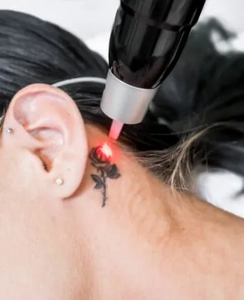 remoción de tatuajes con láser en Toluca renueva tu piel sin cicatrizes