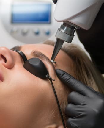 Remoción de micro cejas realizada por profesionales