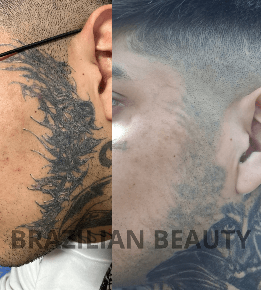 remocion de tatuaje con laser en Toluca