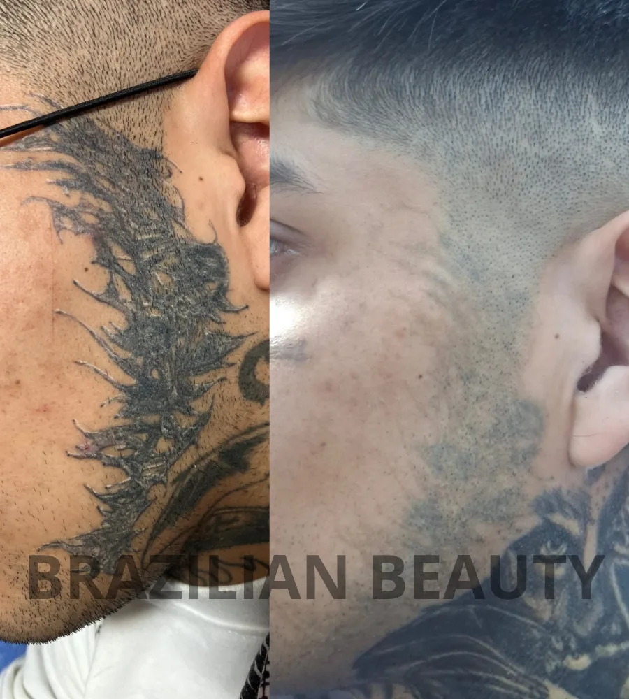 remocion de tatuaje con laser en Toluca