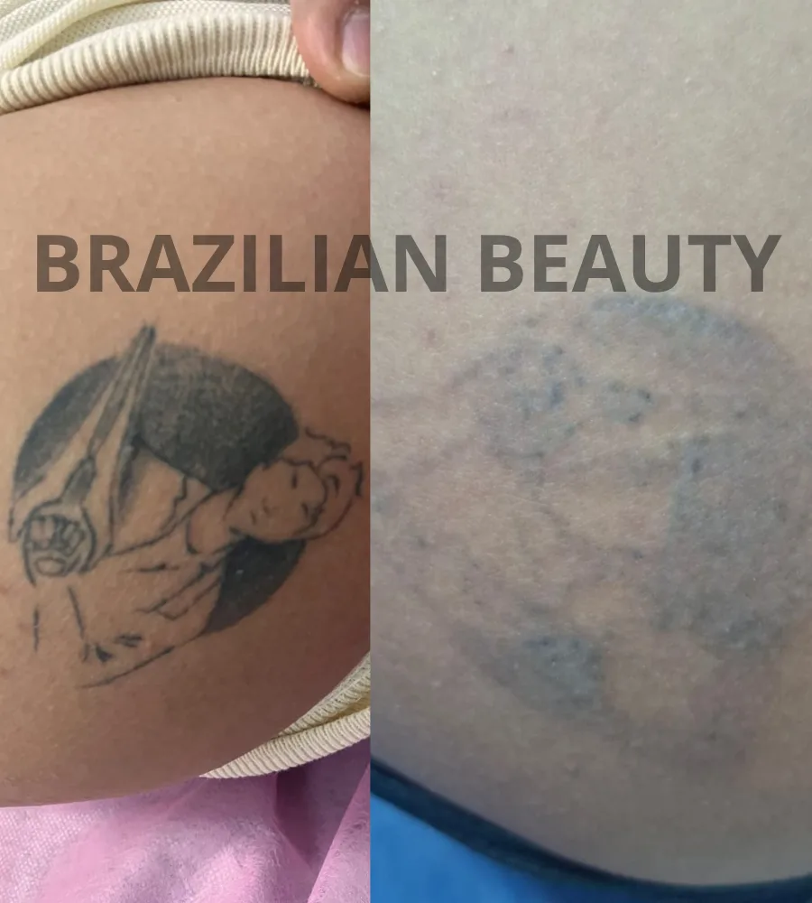 elimina tatuajes en toluca