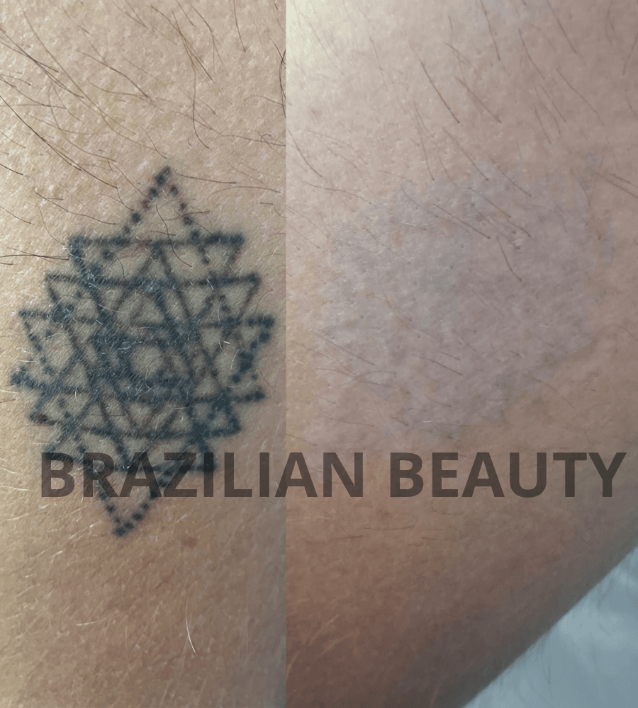 REMOCION DE TATUAJES