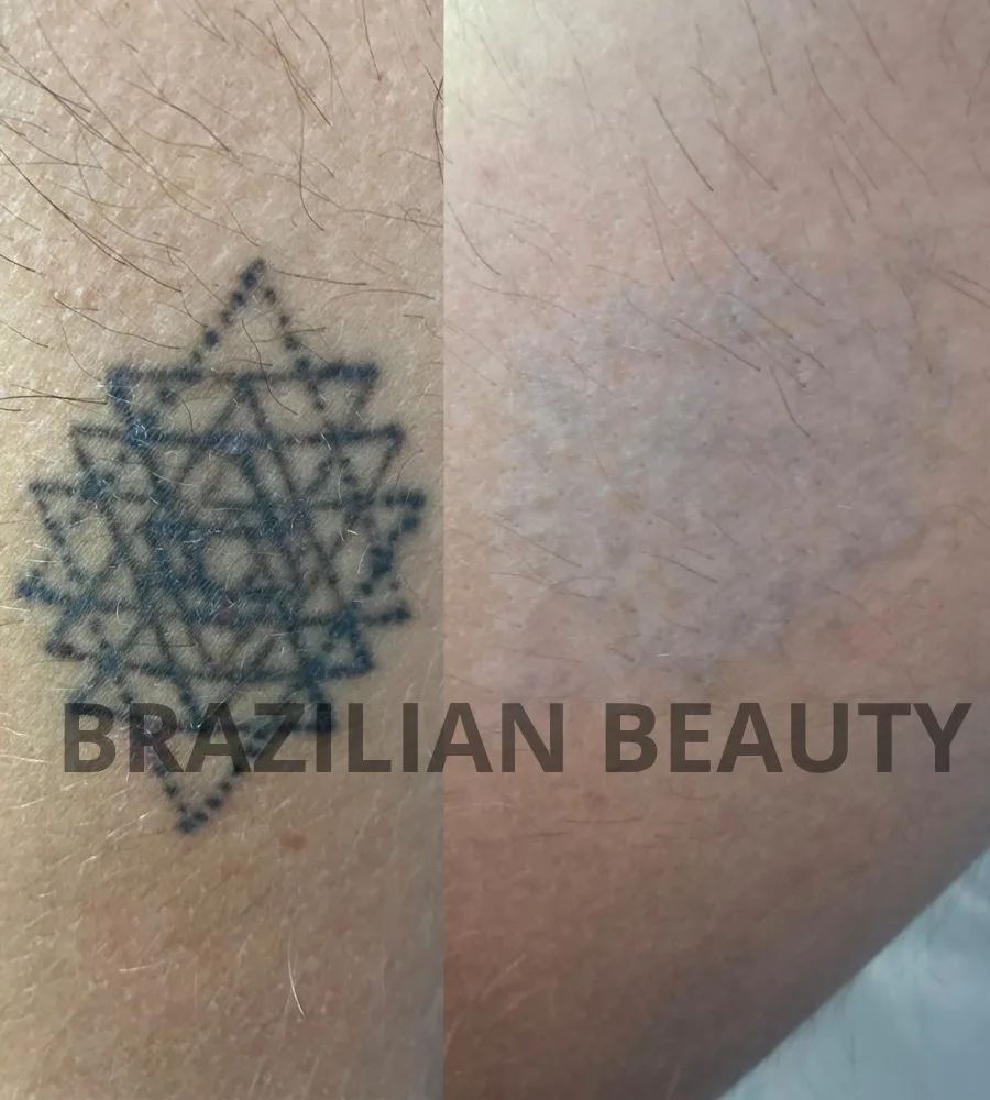 REMOCION DE TATUAJES