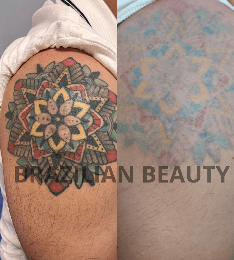 borrar tatuajes color