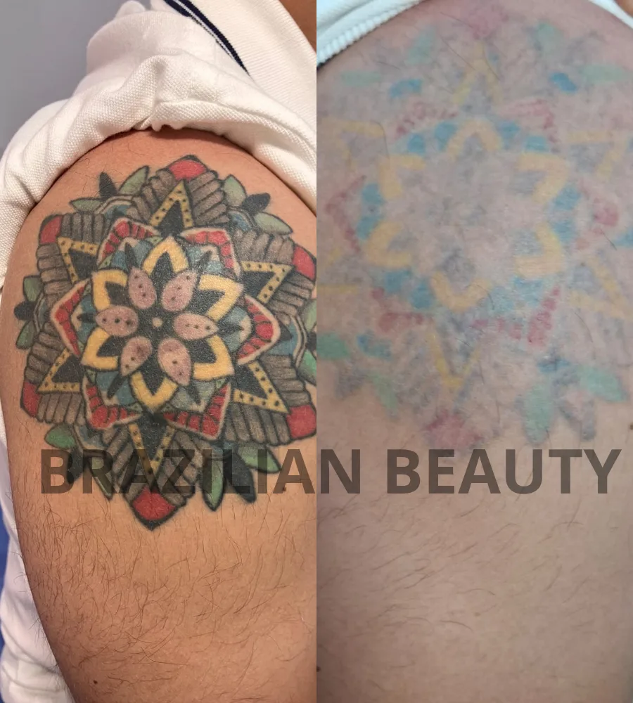 borrar tatuajes color