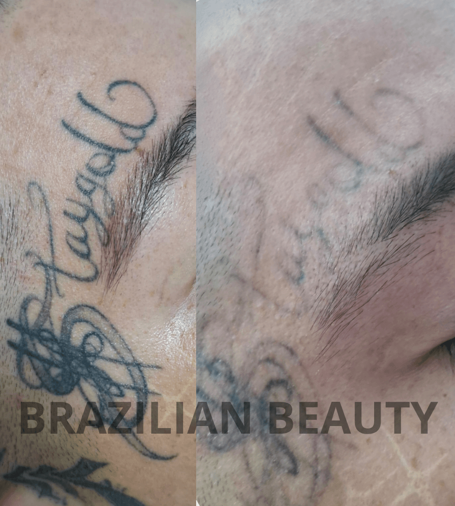 clinica de remocion de tatuajes