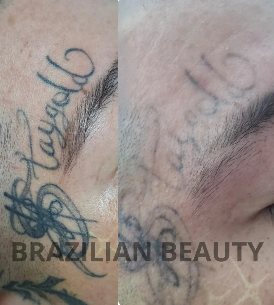 clinica de remocion de tatuajes